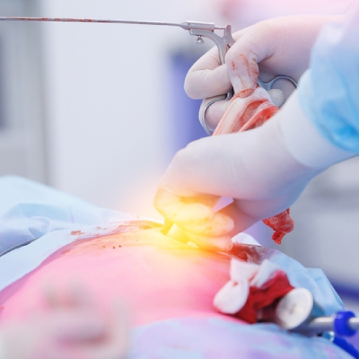 laparoscopy